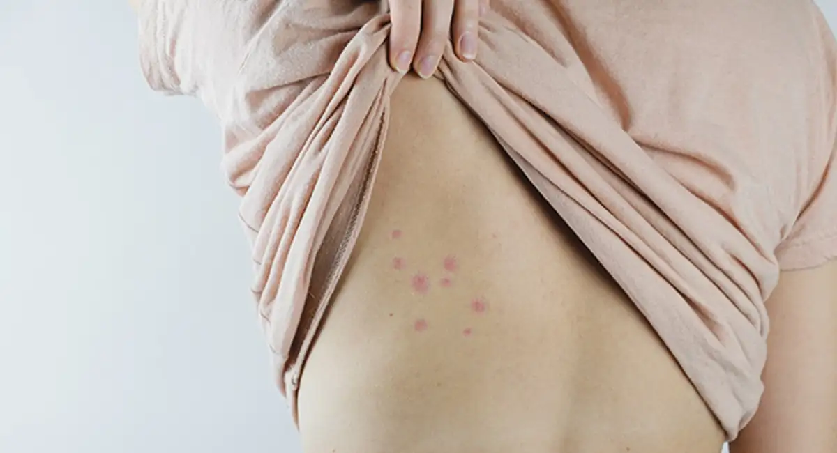 Bed bug bites