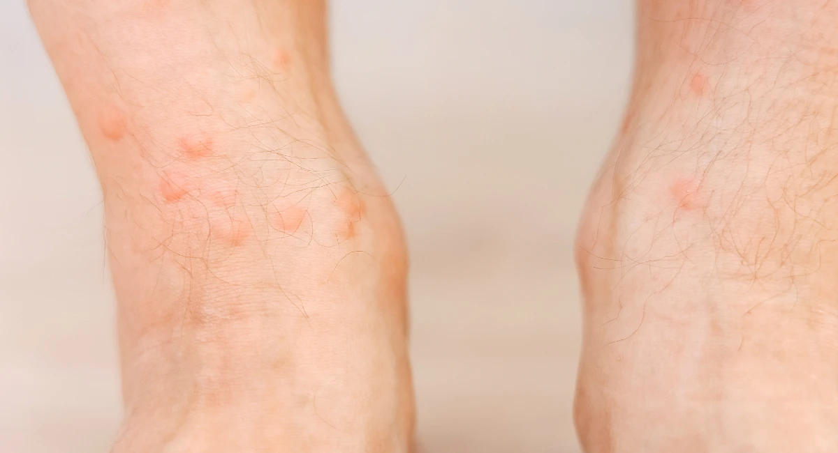 image of bed bug bites and inflamed skin