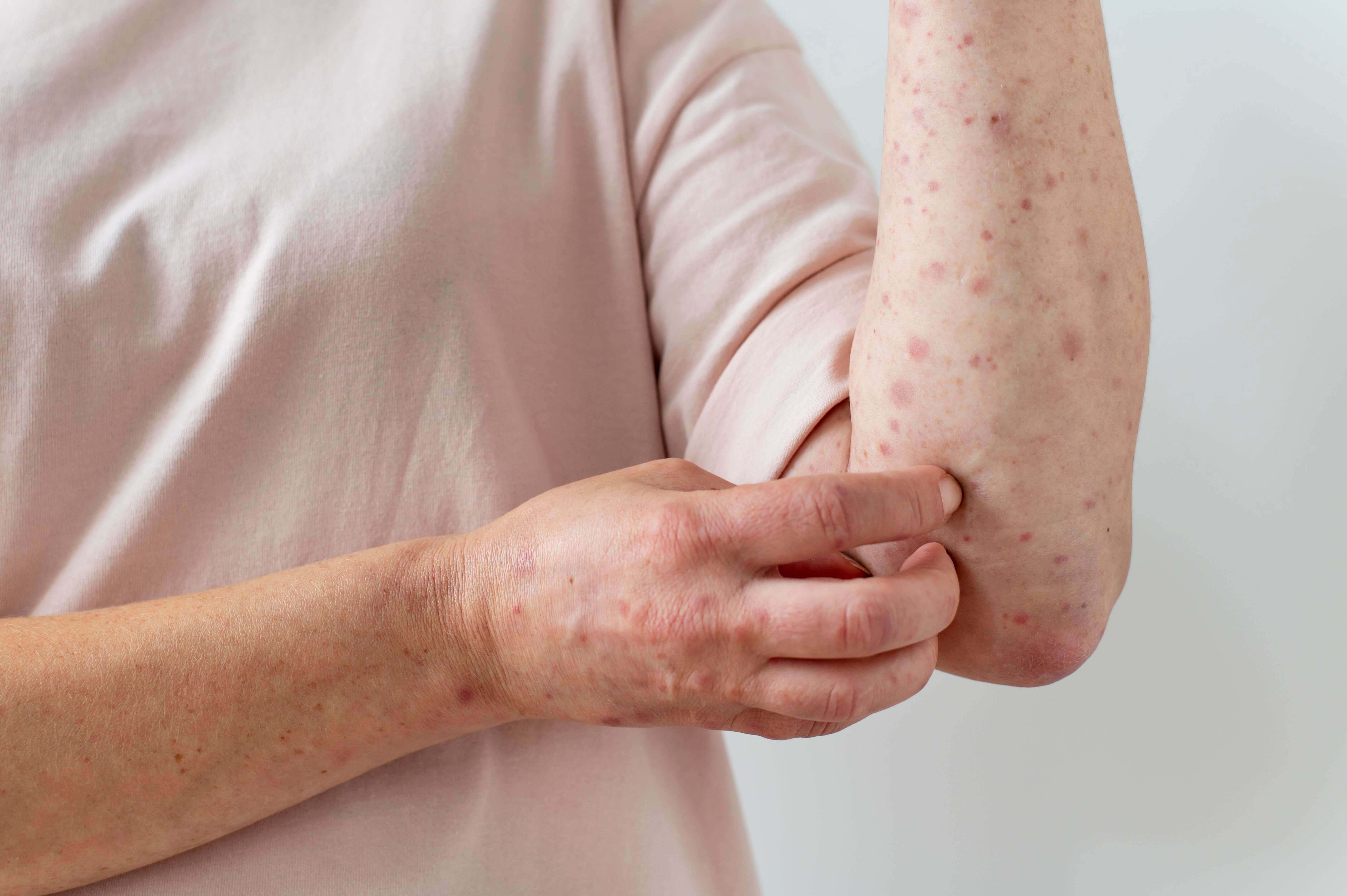 Bedbugs Bites